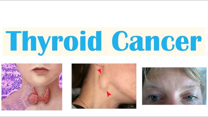 Thyroid Cancer